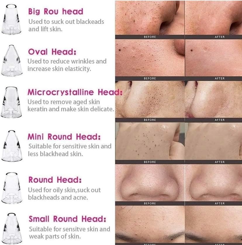 6 In 1 Rechargeable Electric Blackhead & Whitehead Remover Vacuum Pore Cleaner Facial Cleansing Tool view 4