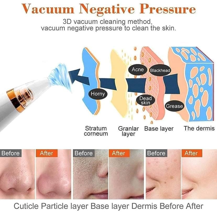 6 In 1 Rechargeable Electric Blackhead & Whitehead Remover Vacuum Pore Cleaner Facial Cleansing Tool view 3